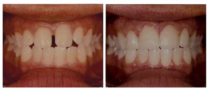 Veneers