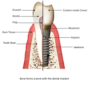 implant